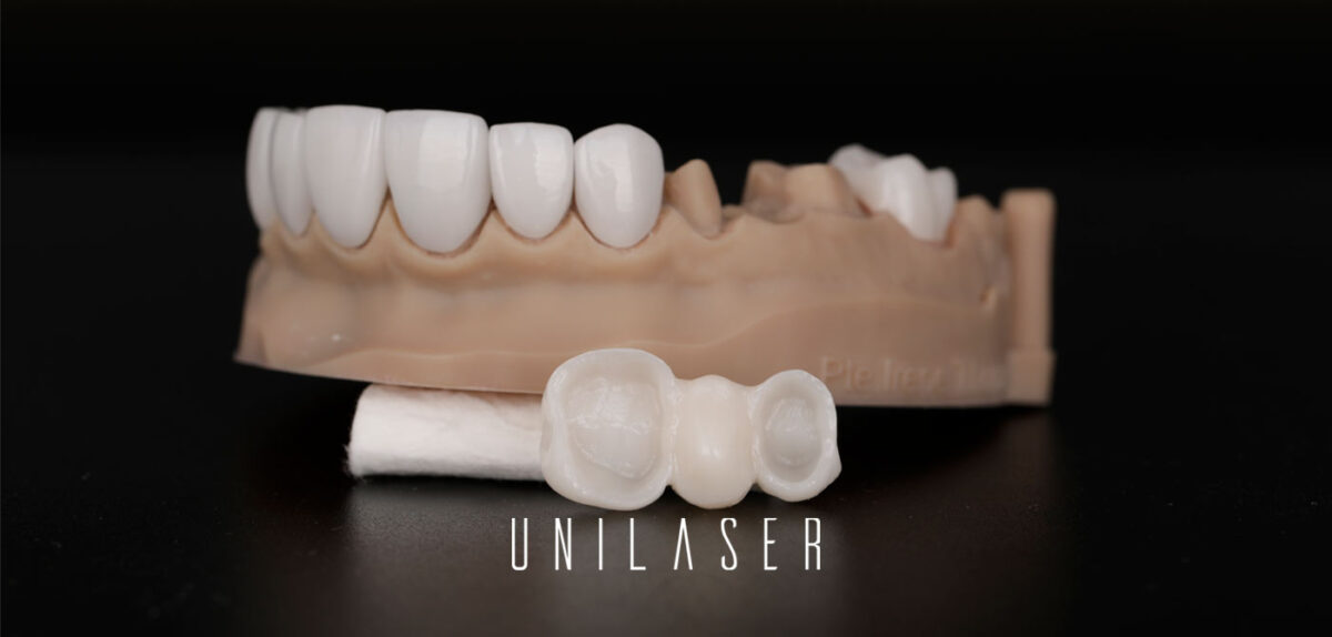 ¿Qué diseño de sonrisa es mejor?, Carillas en Resina o porcelana