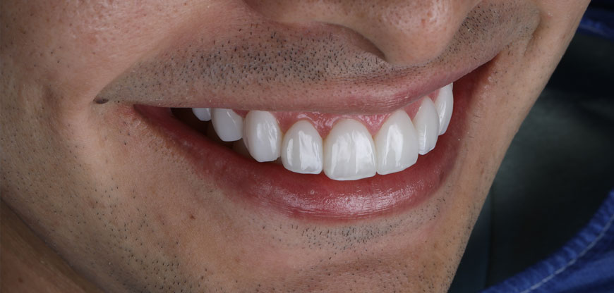 Qué son los brackets invisibles