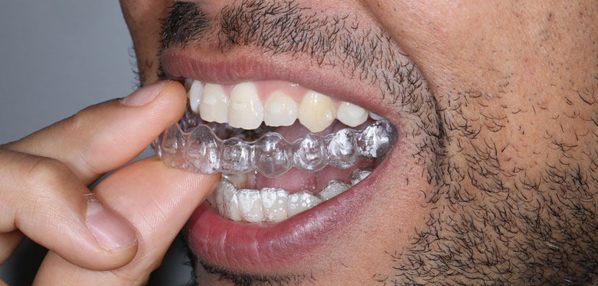 Ventajas de los brackets invisibles